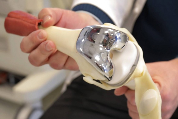 Черкащани можуть безоплатно скористатися послугою із заміни суглобів